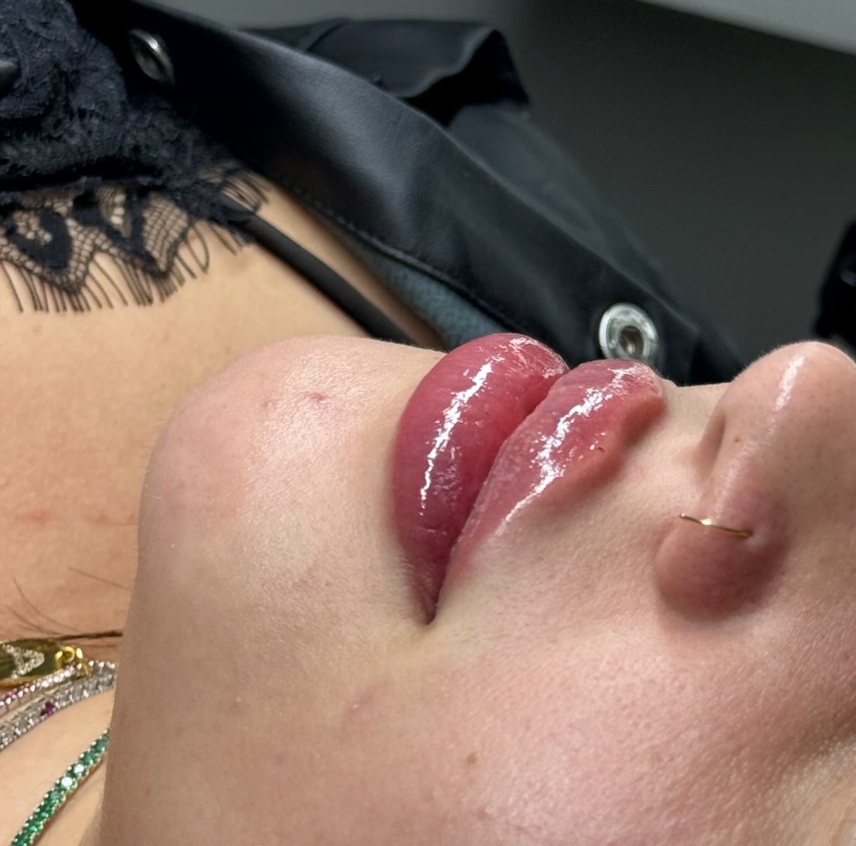 Preenchimento labial