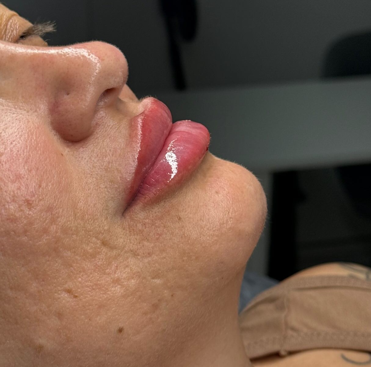 Preenchimento labial